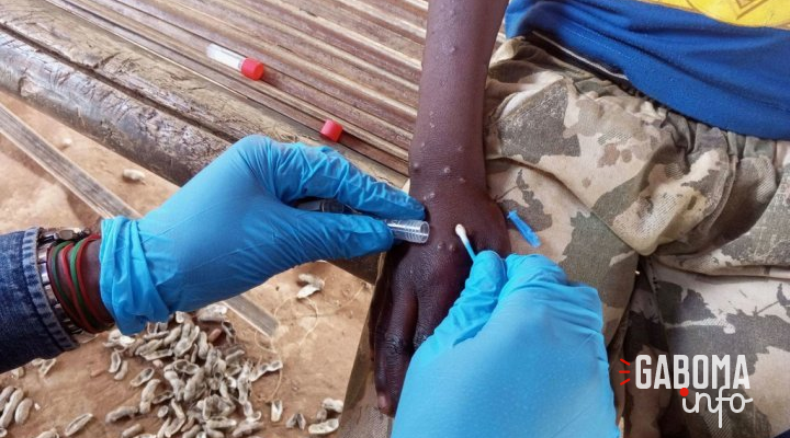 Mpox en Afrique : les enfants particulièrement menacés par la nouvelle variante